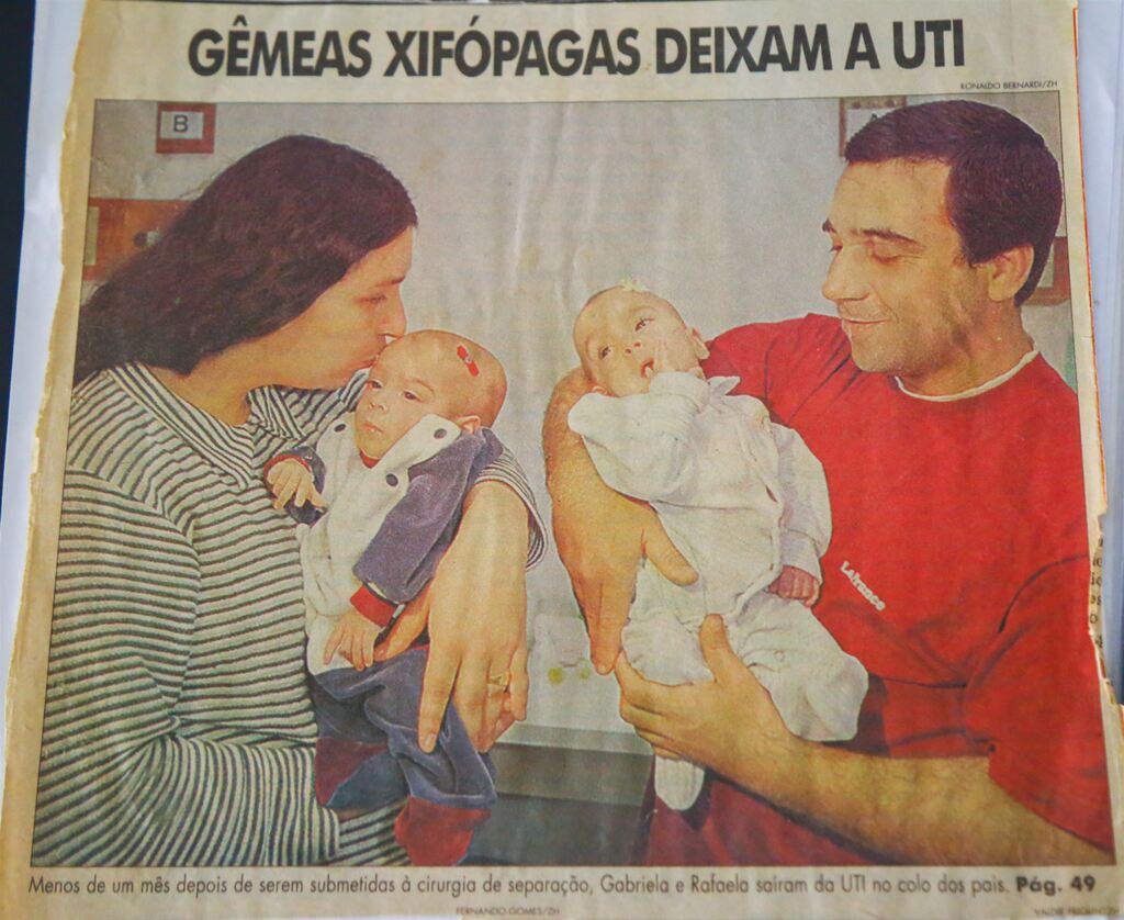 título imagem Gêmea siamesa de Santa Maria relata superação 27 anos após ser separada da irmã