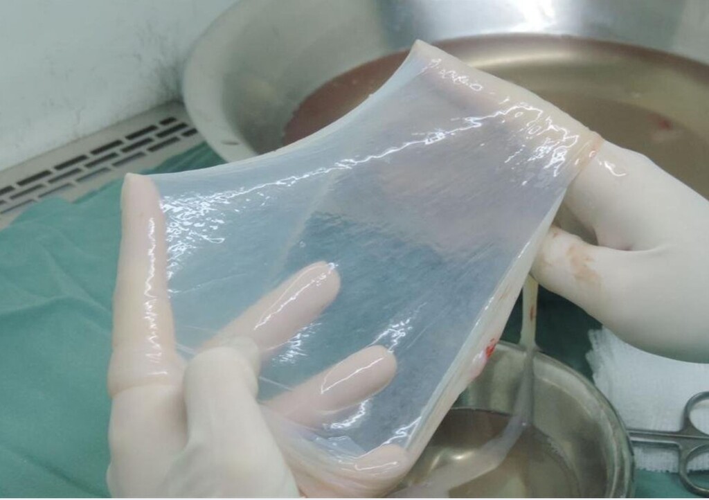 Membrana amniótica pode ser adotada pelo SUS para tratar queimaduras graves