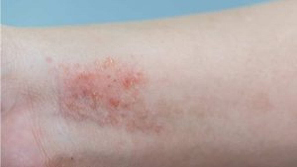 Pacientes com dermatite atópica am a contar com tratamento integral no SUS
