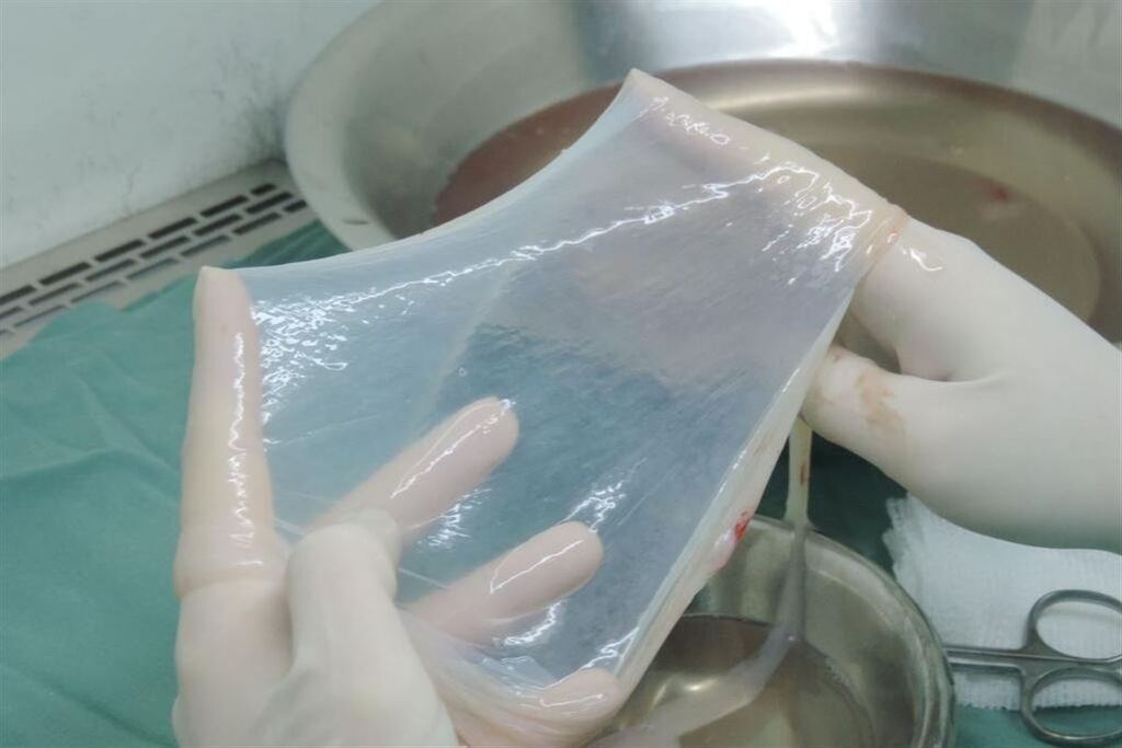 SUS ofertará terapia com transplante da membrana amniótica no tratamento de queimaduras