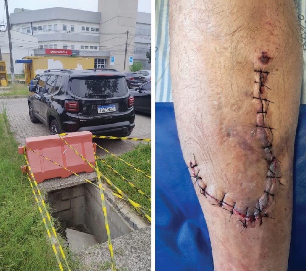 Homem cai em boca de lobo perto do Husm e sofre graves ferimentos