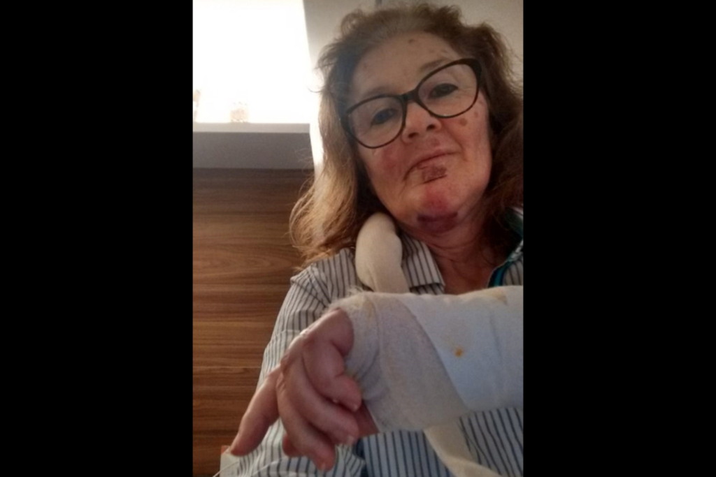 Foto: Arquivo Pessoal - Dois dias após a queda, Maria Elizabeth ainda se recupera