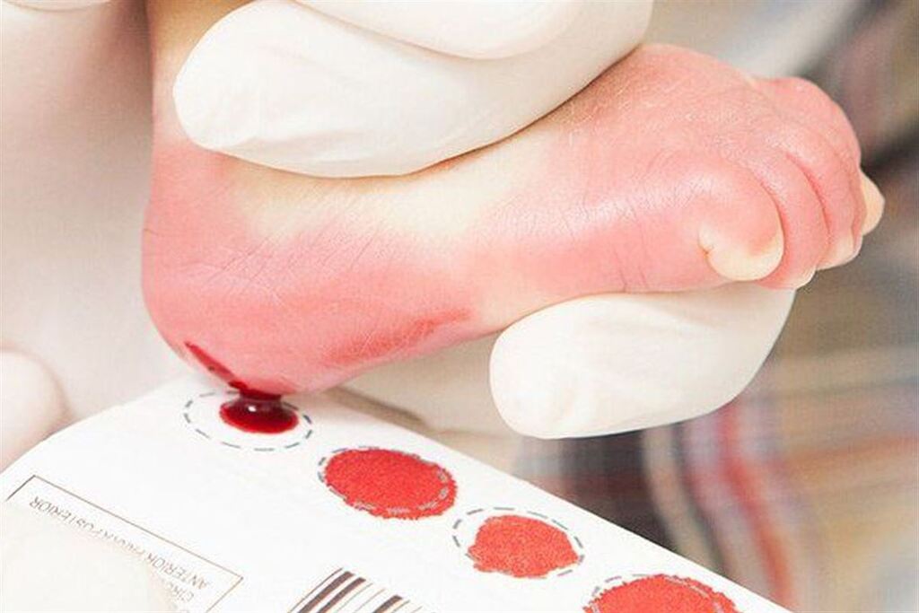 título imagem Procedimento para detecção precoce de doença ultrarrara em crianças será incorporado no SUS