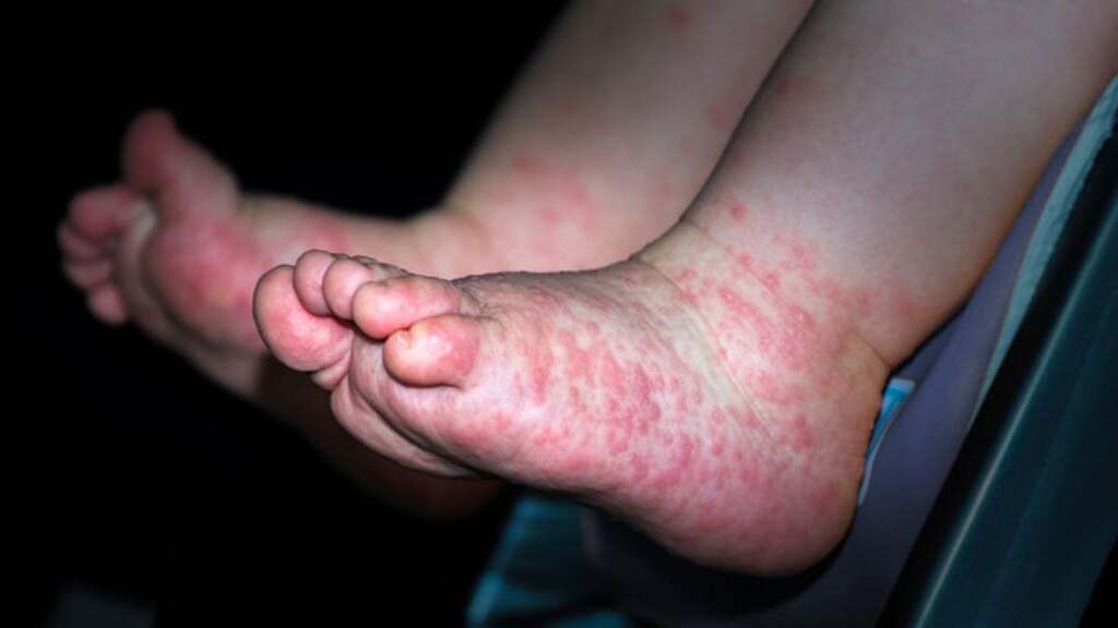 Centro Estadual de Vigilância em Saúde registra novo surto de Síndrome Mão-Pé-Boca em crianças