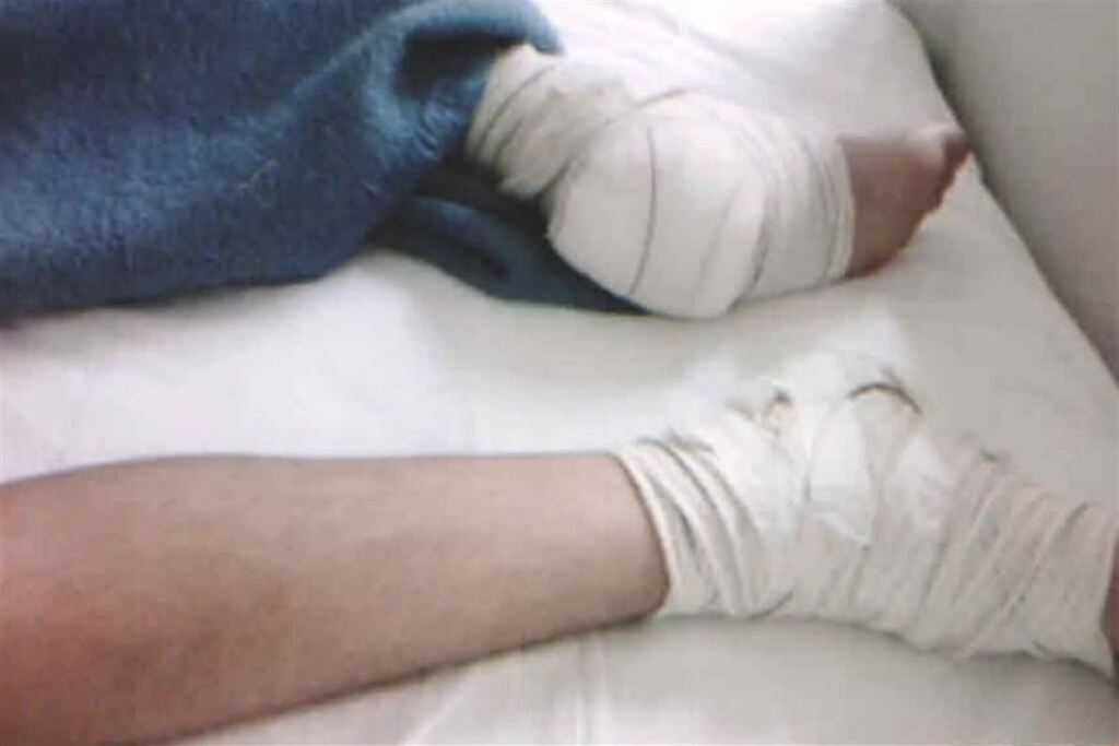 Após cirurgia em pé errado de paciente, UFSM e médicos são obrigados a pagar cerca de R$ 50 mil de indenização