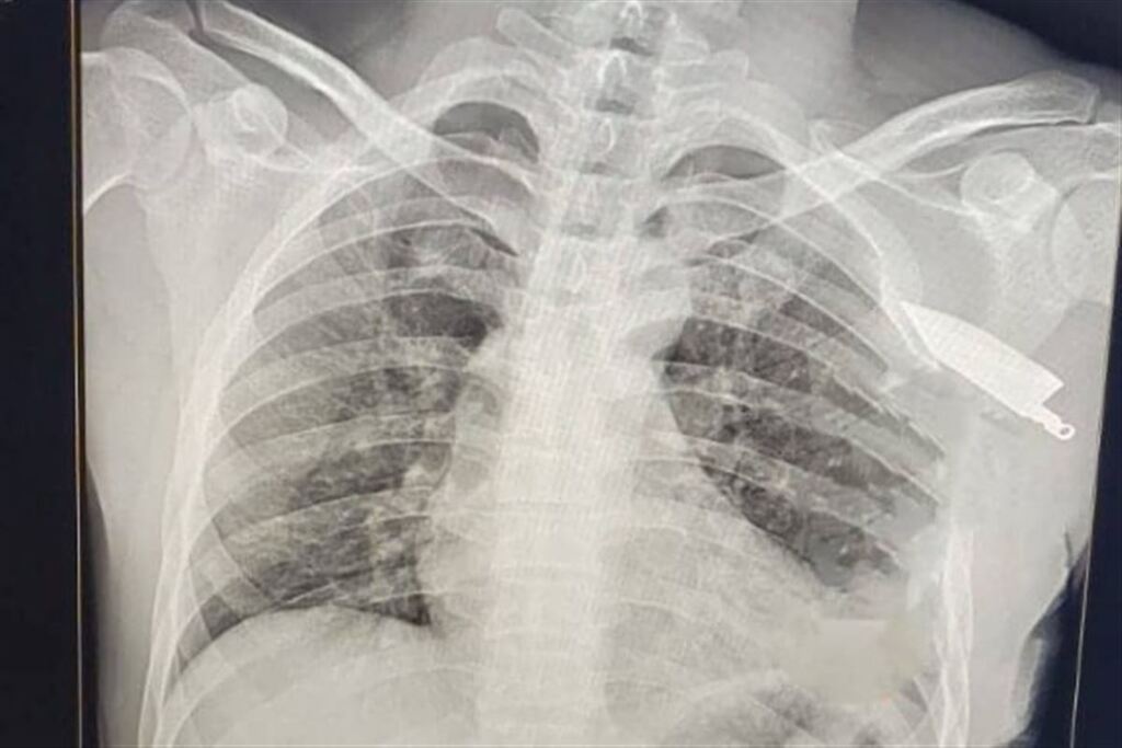 Homem fica com faca presa na clavícula após tentativa de assassinato em Rosário do Sul