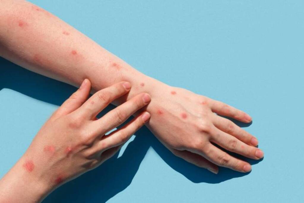 Paraíso do Sul tem um caso suspeito de varíola dos macacos