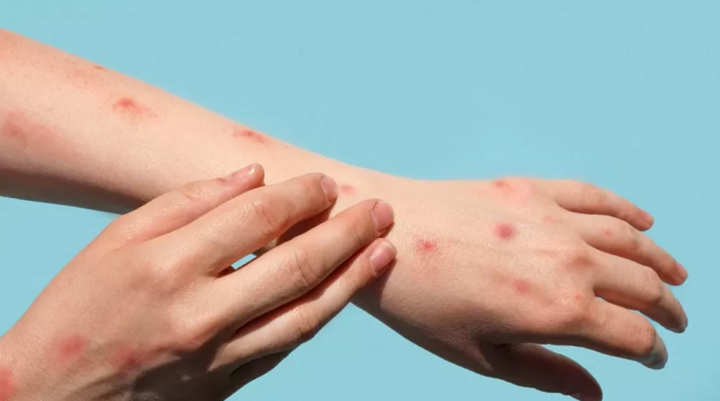 Estado confirma transmissão comunitária da varíola do macaco