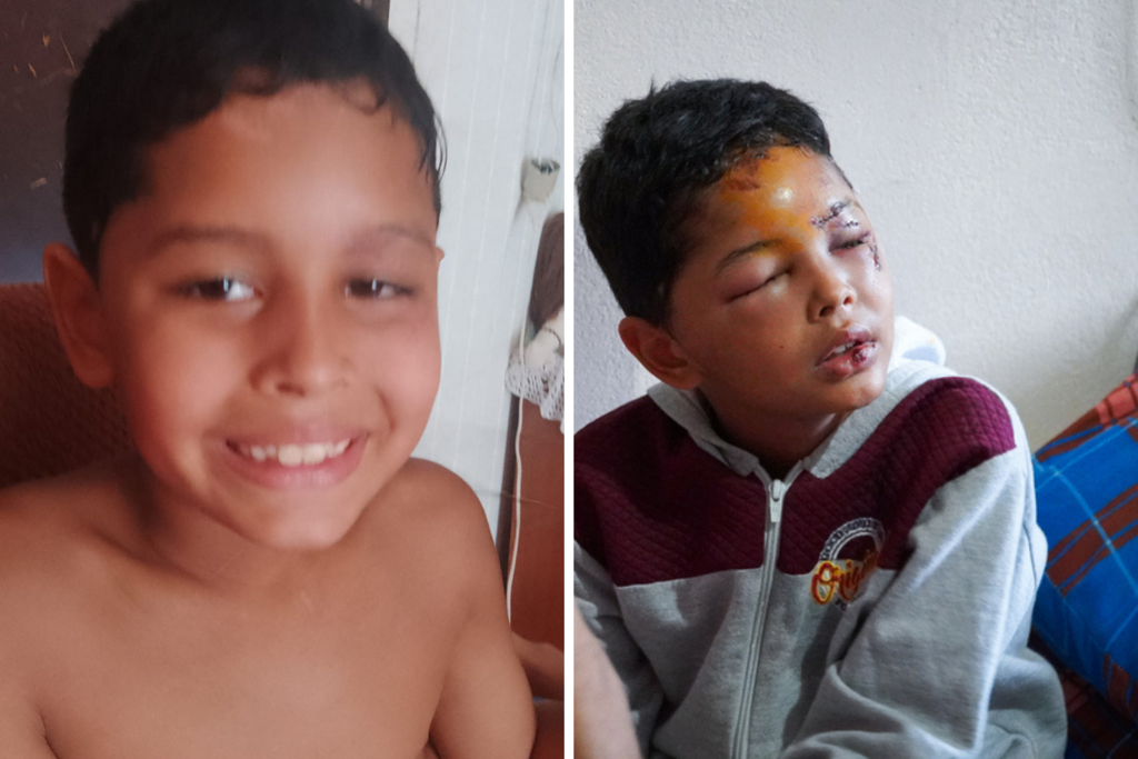 Um mês após cair em bueiro em Cruz Alta, menino de 7 anos está recuperado