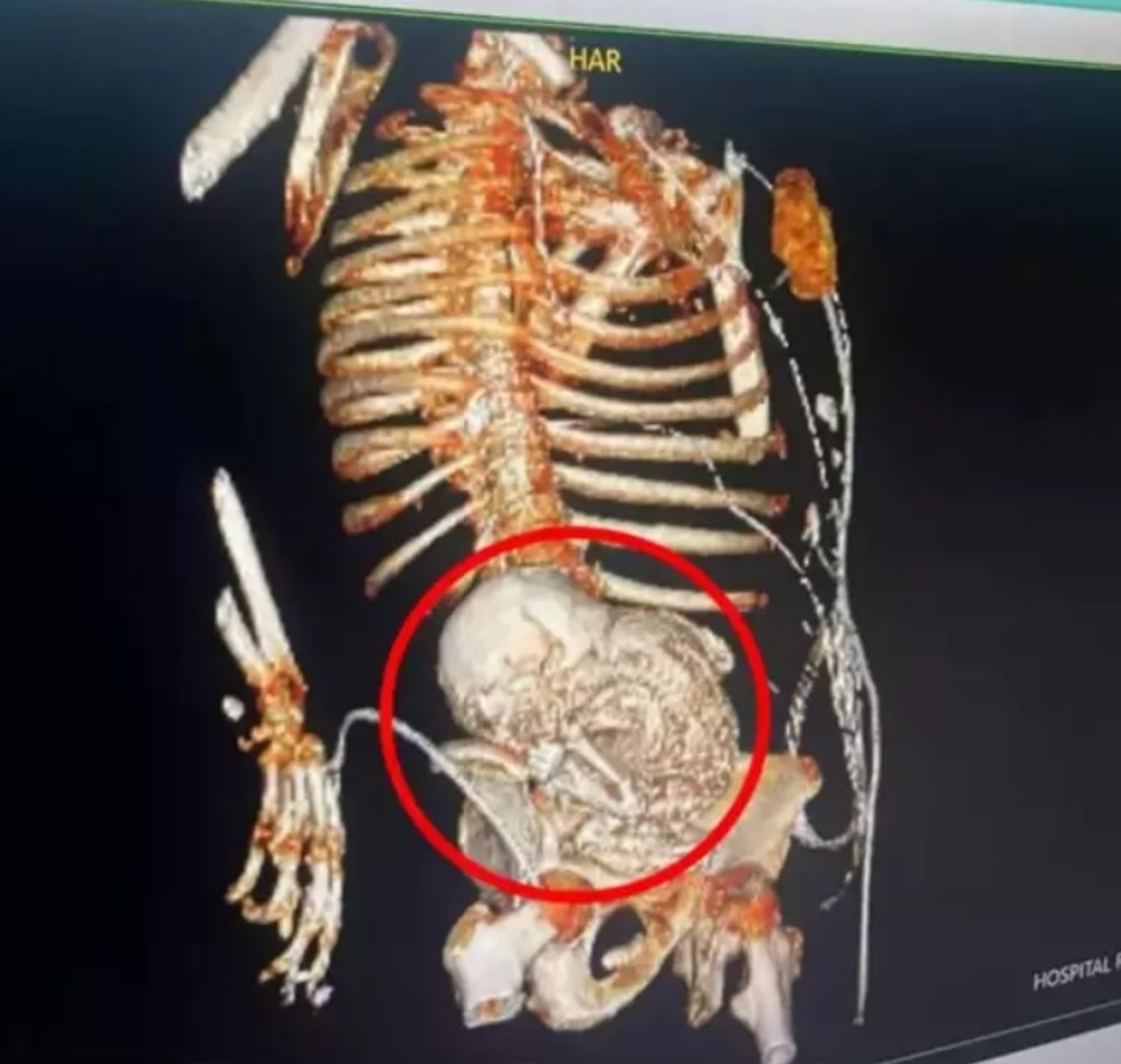 Descoberta inusitada: exame revela que idosa carregava feto petrificado há 50 anos